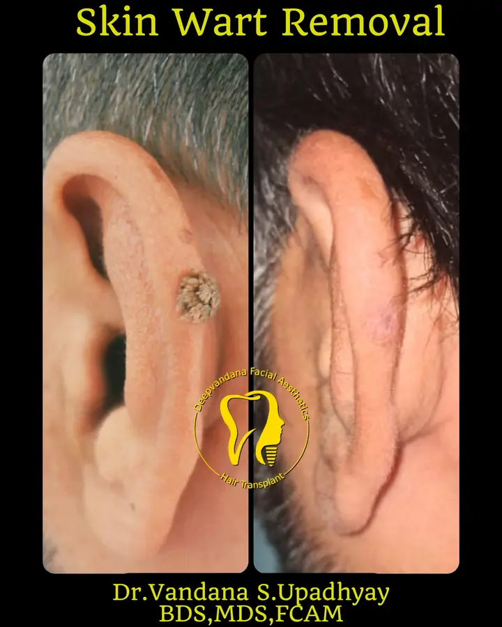 Skin wart removal result