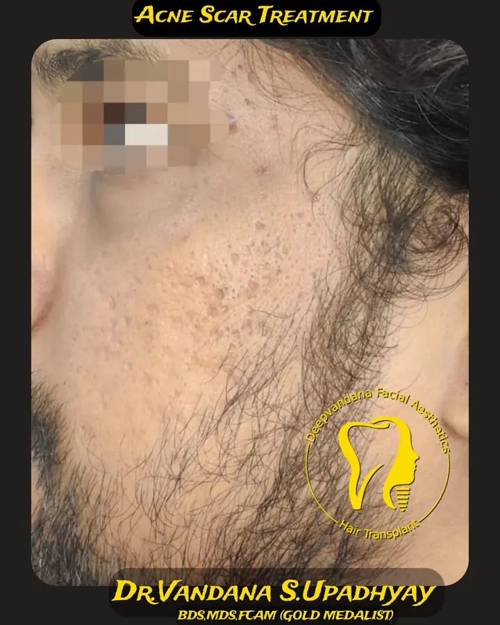 Acne scar treatment