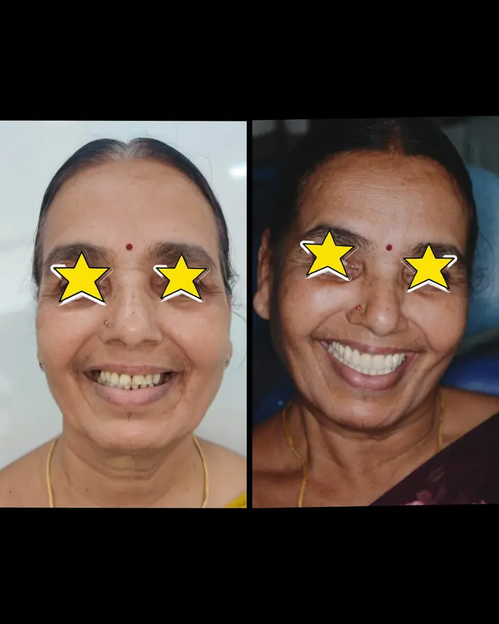 Full-Mouth Crowns