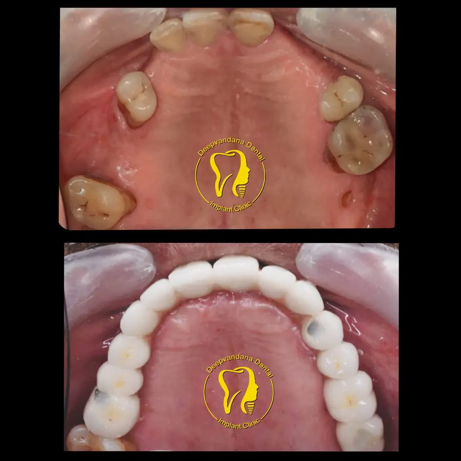 Implant-supported arch view