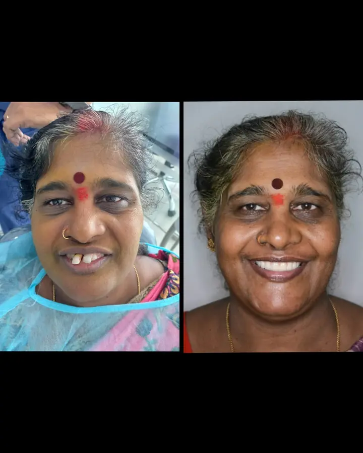 Full-mouth implant smile result