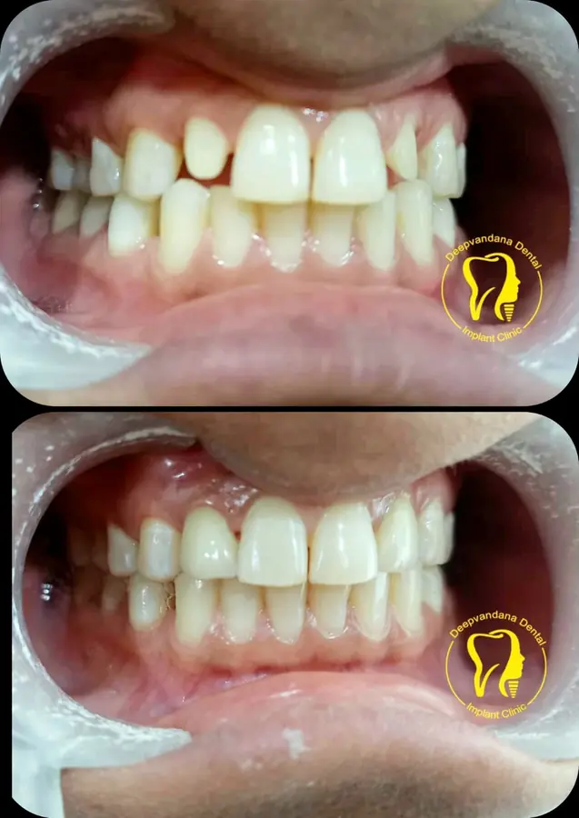 Smile makeover case 6