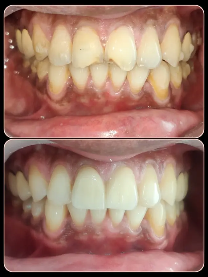Smile makeover case 7