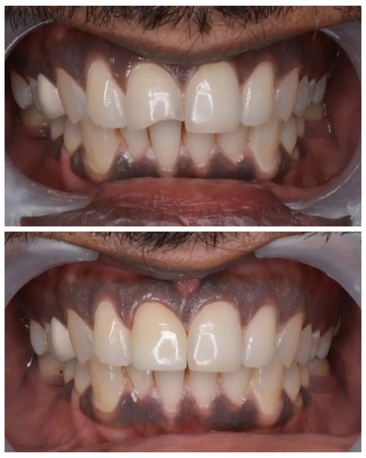 Smile makeover case 8
