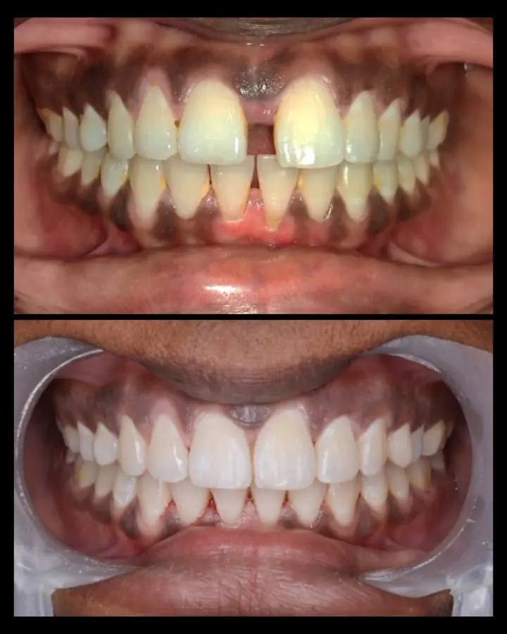 Smile makeover case 12